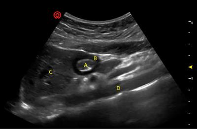 Predictive value of preoperative ultrasonographic measurement of gastric morphology for the occurrence of postoperative nausea and vomiting among patients undergoing gynecological laparoscopic surgery